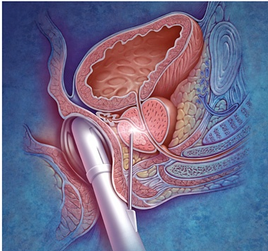 Slika 1 biopsija prostate